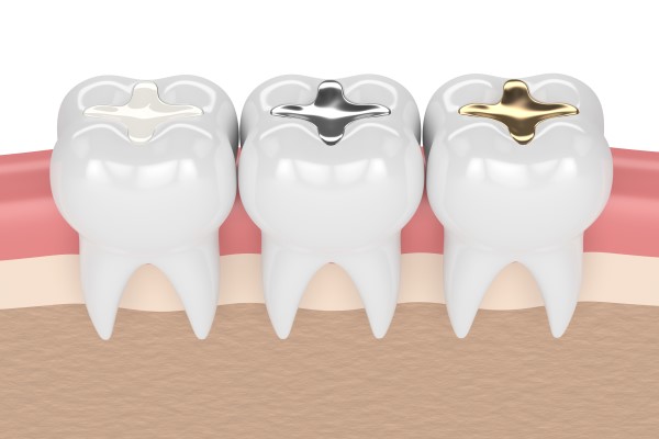 Dental Fillings: A Dental Restoration To Treat Cavities