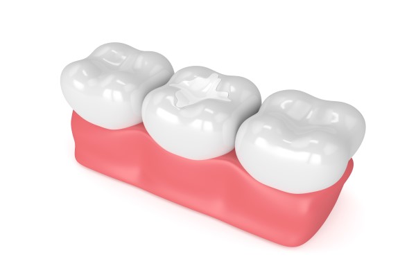 FAQs About Tooth Colored Fillings