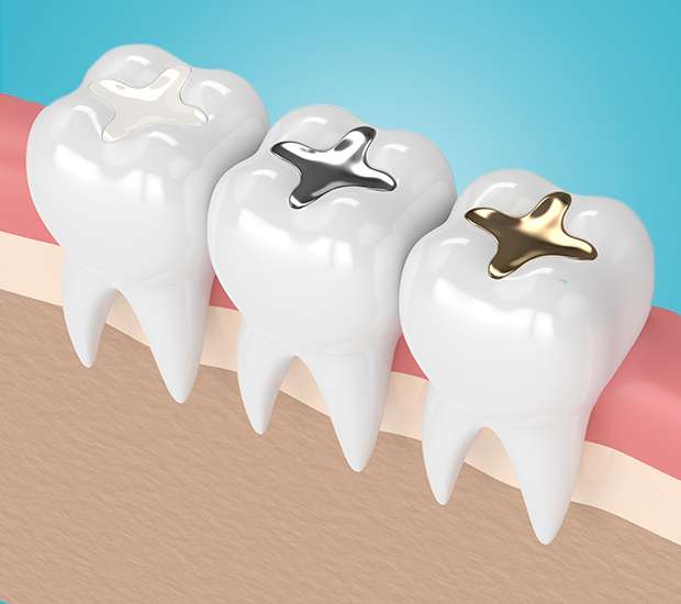 Mableton Composite Fillings