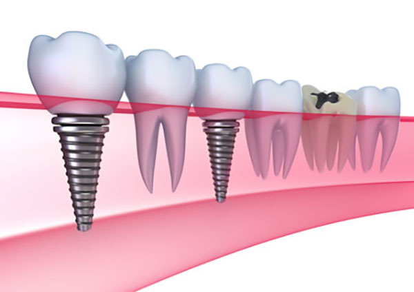 Options To Replace Lost Teeth