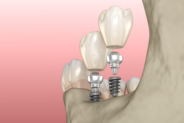 Dental Implants Mableton, GA