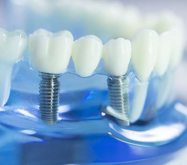 Mableton Dental Implants