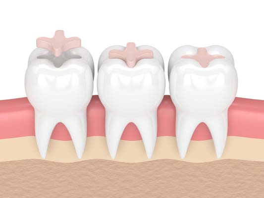 Can Dental Sealants Be Used For Adults?