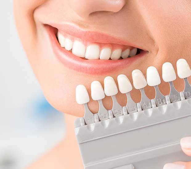 Mableton Dental Veneers and Dental Laminates