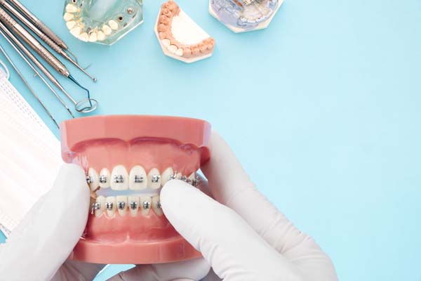 Taking Care Of Teeth After Orthodontics Treatment