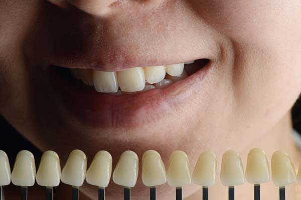 Who Is A Good Candidate For A Smile Makeover?