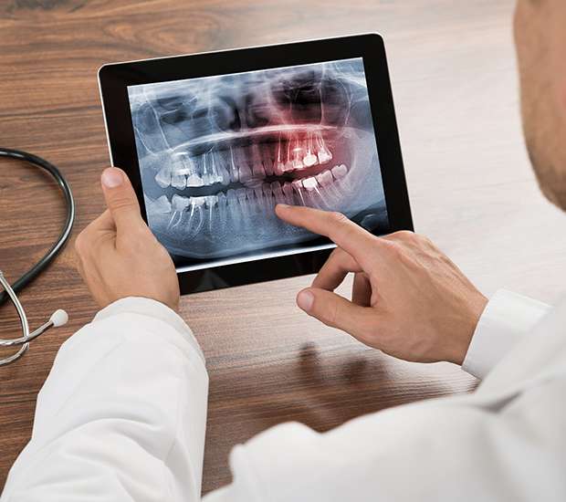 Mableton Types of Dental Root Fractures